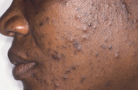 acne on black skin
