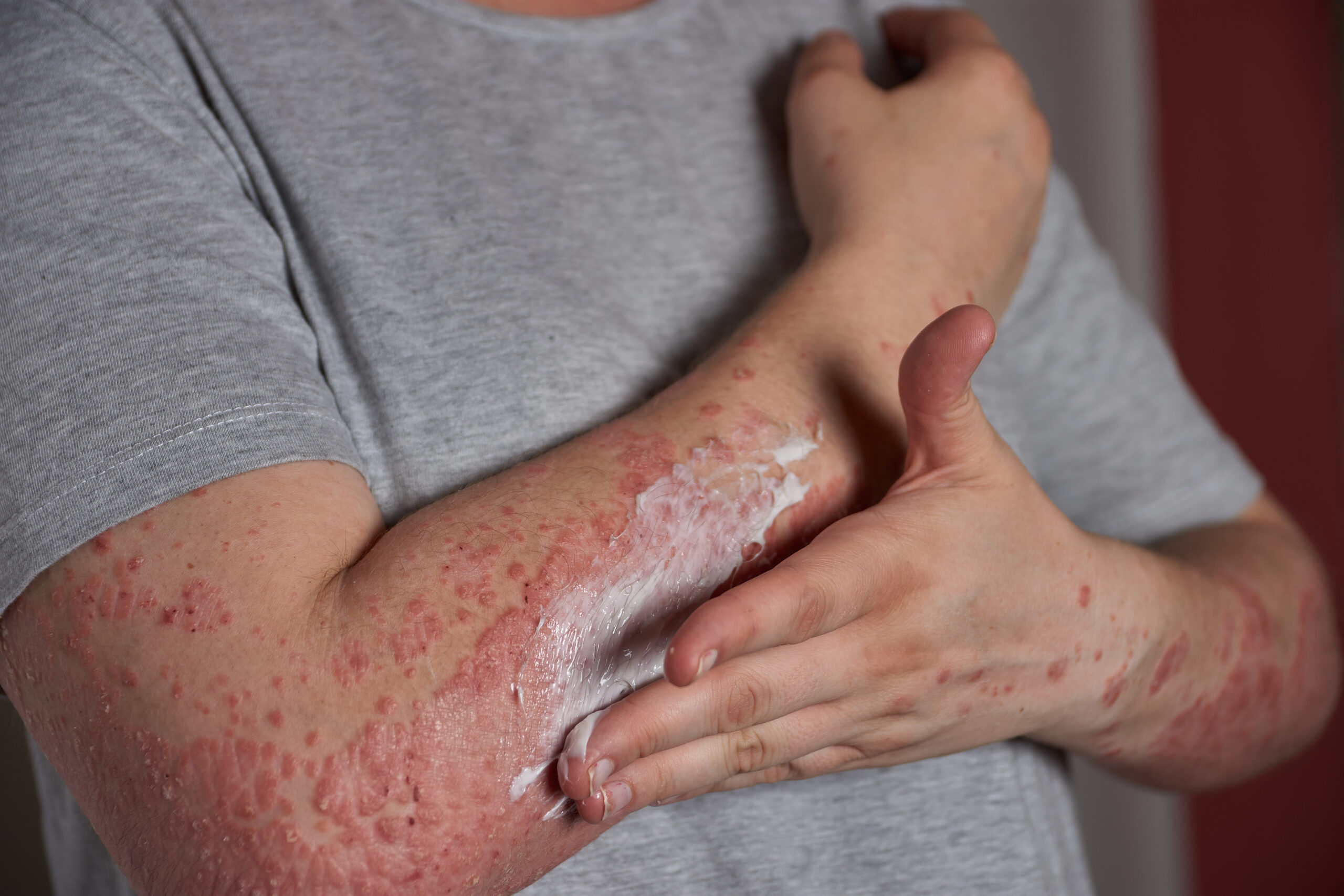 applying moisturizer to skin with psoriasis