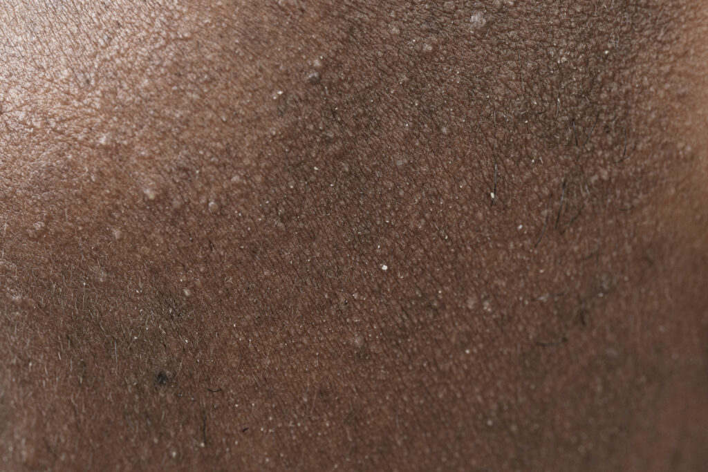 Fungal infection close up skin pores face care routine