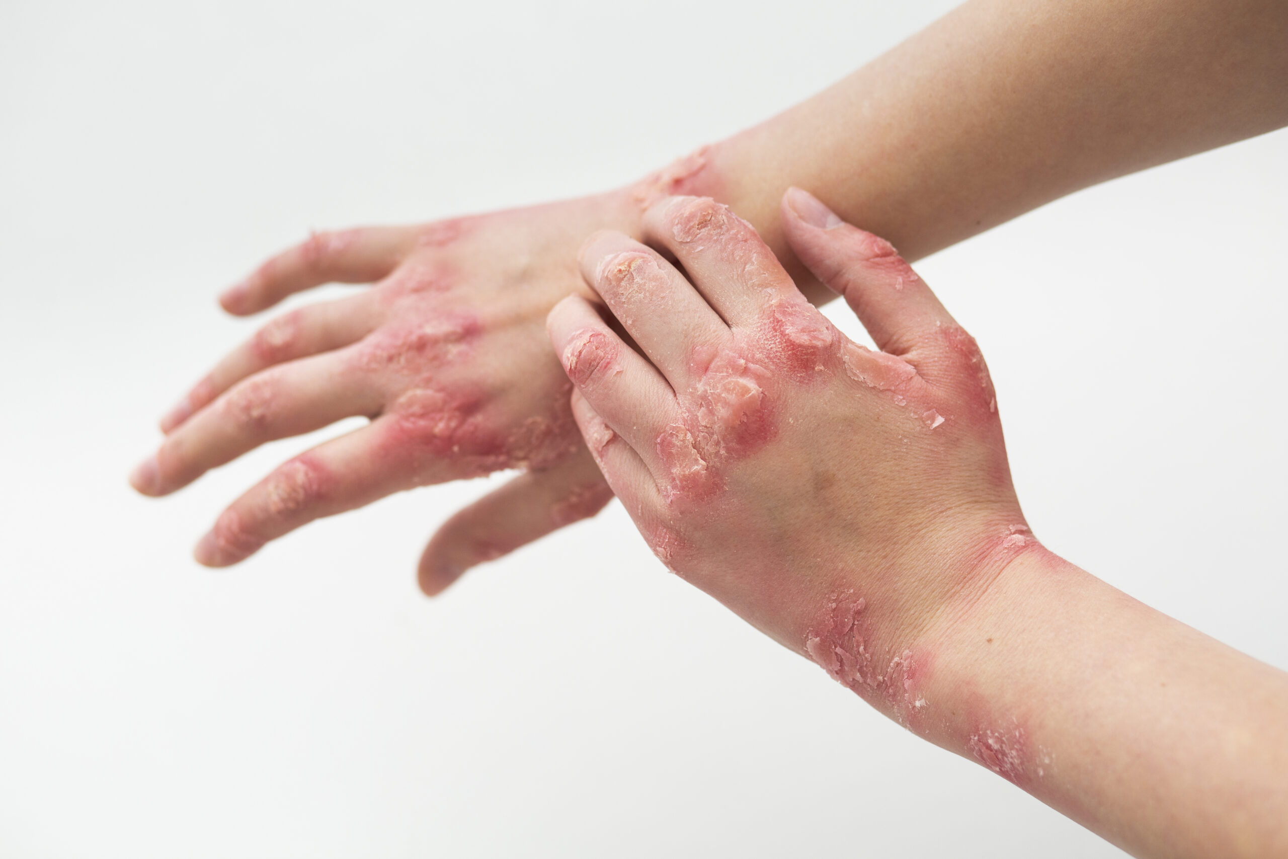 hands patient suffering from psoriasis