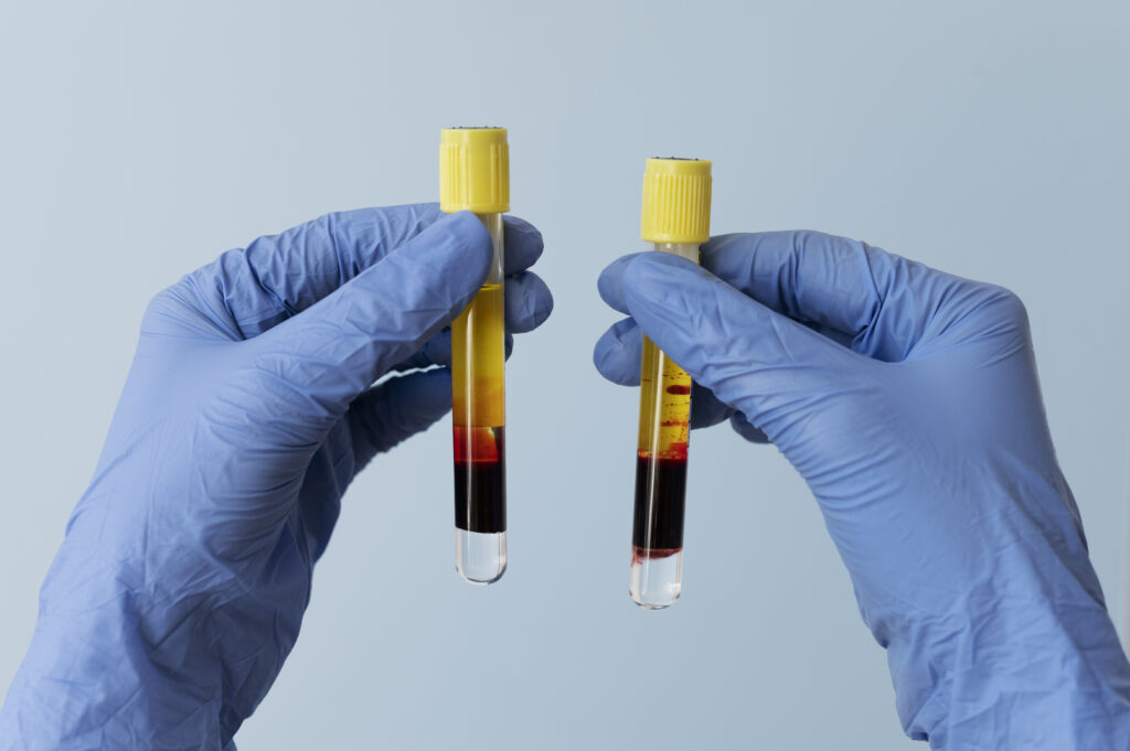 Platelet rich plasma hands with gloves holding vials prp