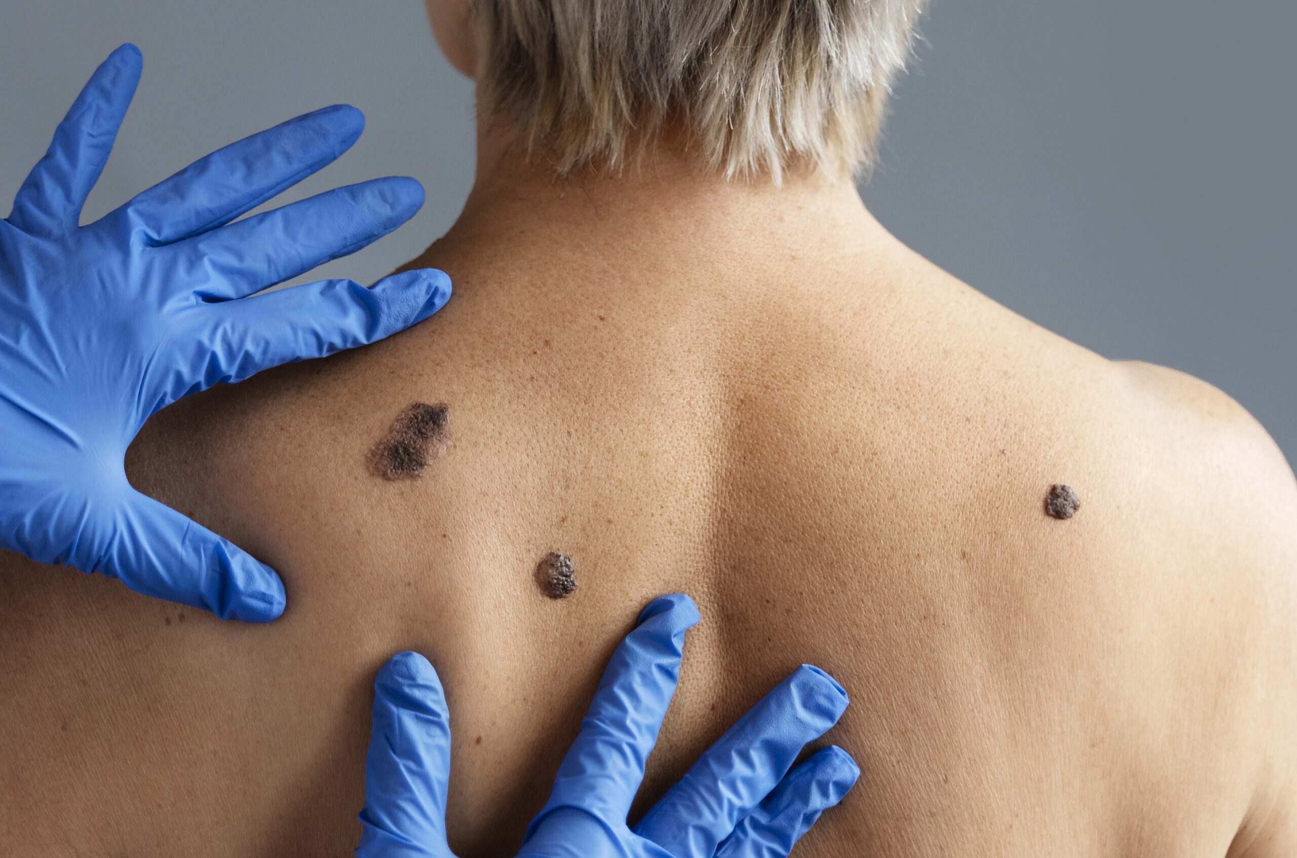 hands with gloves touching skin with melanoma