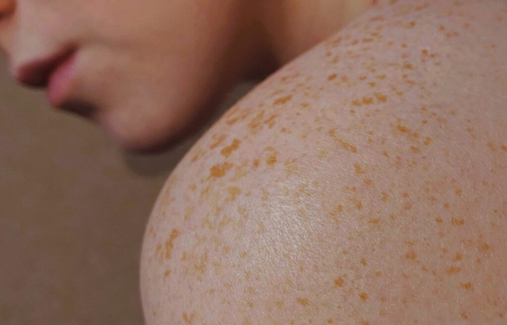 Melasma valeria smirnova xek8bas1vqi unsplash